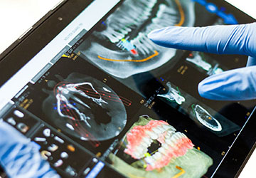 implantologia guiada ordenador implantologia guiada ordenador