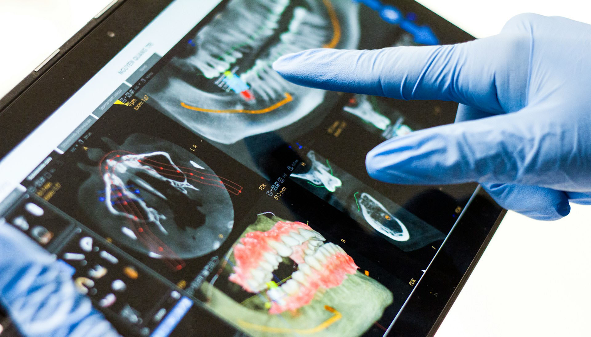 implantologia guiada ordenador